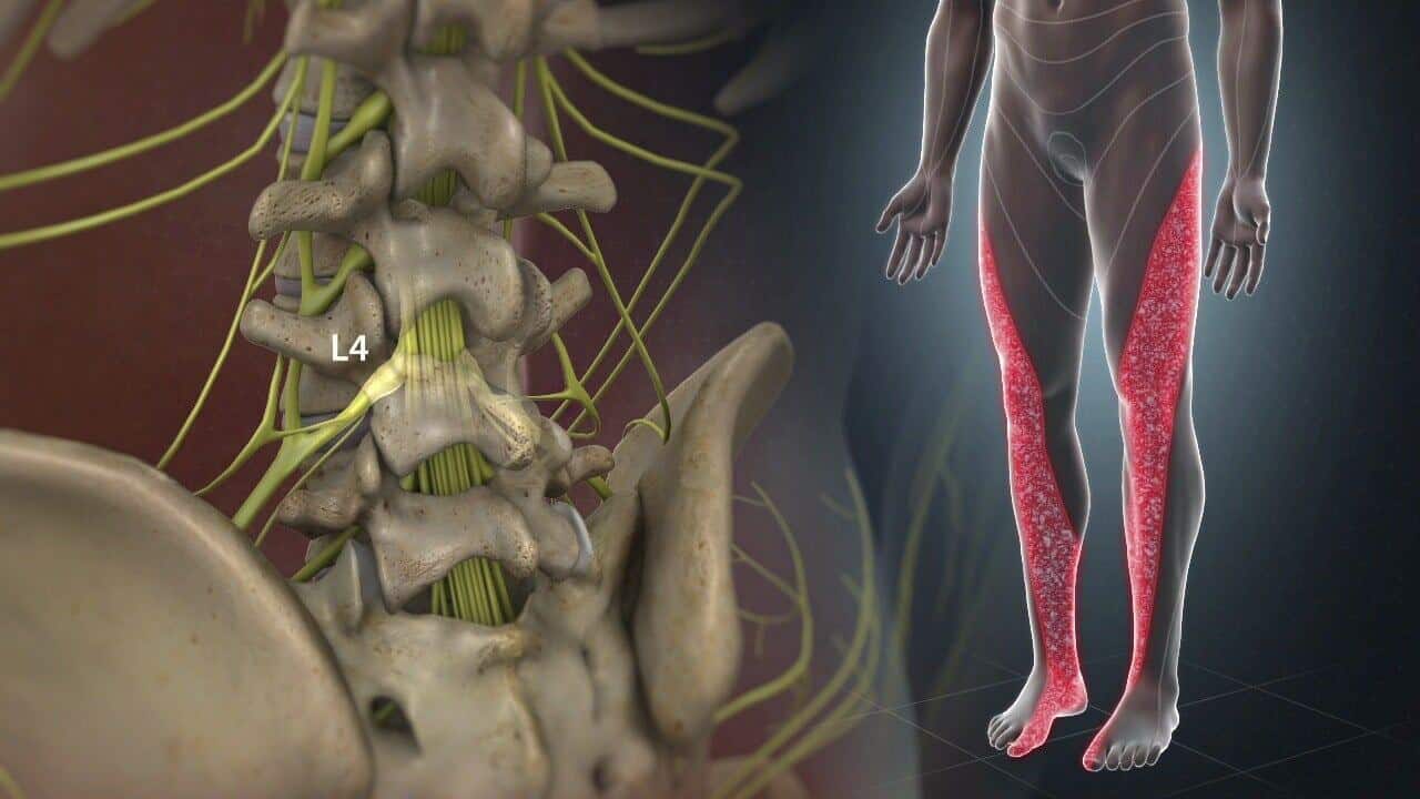 lumradsciatica_1280_20(1)